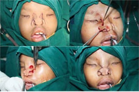 Surgeon drills through nine-year-old’s mouth to reshape face