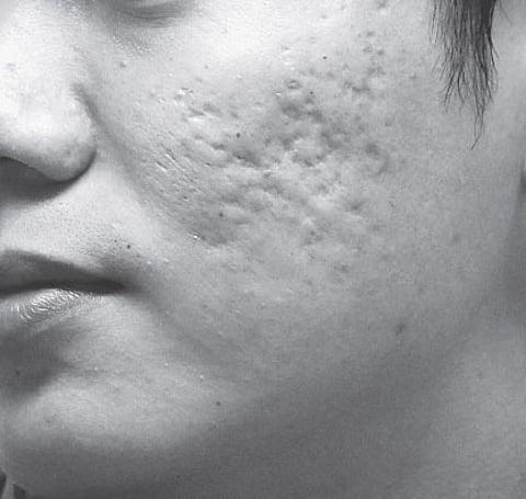 Save yourself from scarring