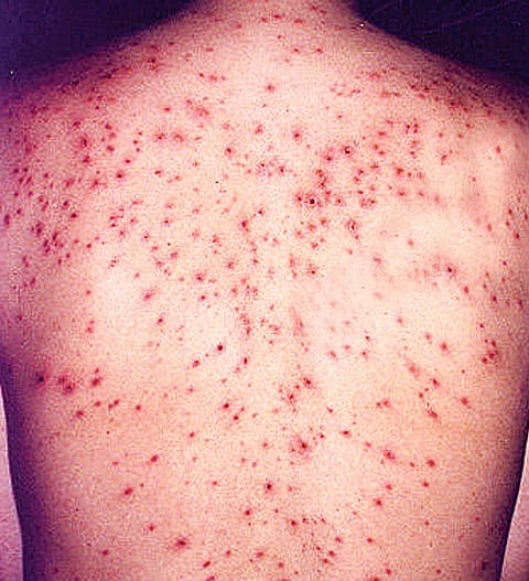 Summer hurts as Typhoid cases double this year