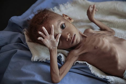 Malnourished boy sits on a hospital bed at the Aslam Health Center, Hajjah, Yemen. (Photo| AP)