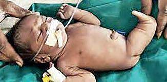 Hyderabad: Baby born with mermaid syndrome dies