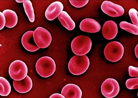 Pandemic: Anaemia on the rise among Telangana women