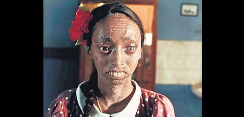 Nisha Lobo was born with a rare genetic condition called ichthyosis.