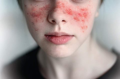 Living with lupus