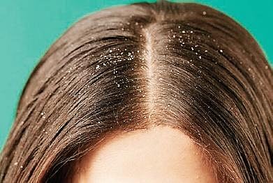But a dry itchy scalp could be an indication of sensitivity, hence it needs to be properly diagnosed.