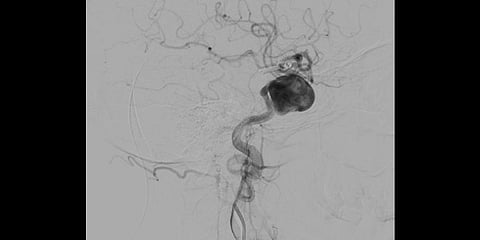 A brain aneurysm is a sac or a bulge in the wall of an artery supplying the brain that balloons out and is filled with blood.