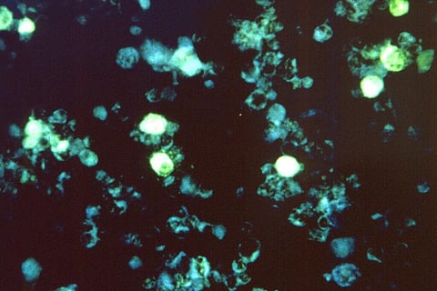 Cells infected with Epstein-Barr, a common herpes virus that can cause mononucleosis and establishes a latent, lifelong infection of the host. (Image Courtesy | The Harvard Gazette)