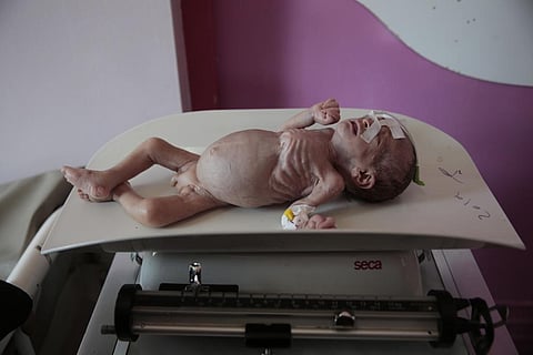 A malnourished boy Maher Ahmed is placed on a scale at a feeding center at Al-Sabeen hospital in Sanaa, Yemen, Nov. 3, 2020. (AP Photo)