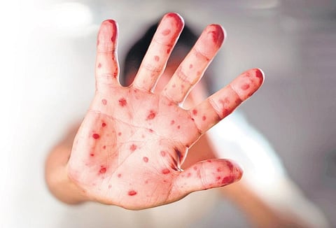 Monkeypox mayhem