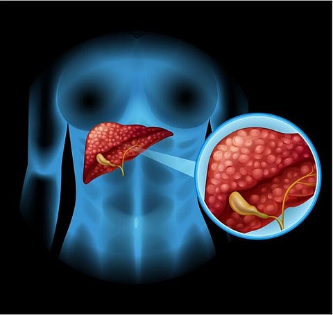 Pancreatic cancer is the twelfth most common cancer globally, but it accounts for five per cent of cancer-related deaths due to its high fatality rate.