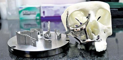 The face implants are 3D-printed using medical-grade titanium. (Inset) Murugaiyan Amirthalingam, asst professor at IIT-M | Express