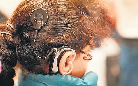 For representational image. The State Health Agency (SHA) has recently approved over Rs 59 lakh to upgrade cochlear implantation machines for 25 children.