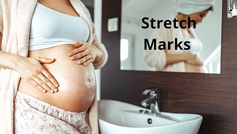 Stretch Marks कमी करण्यासाठी करा हे घरगुती उपाय