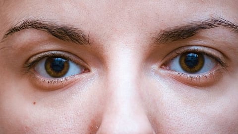 dark circles