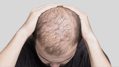 Bald People