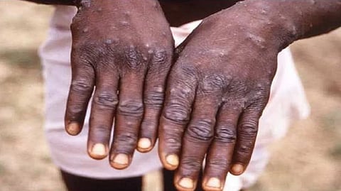 Monkeypox Symptoms & Precautions