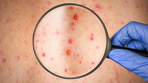 Monkeypox