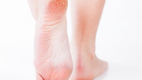 Cracked Heels