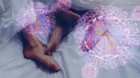 Monkeypox