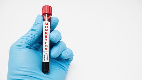 Monkeypox Virus