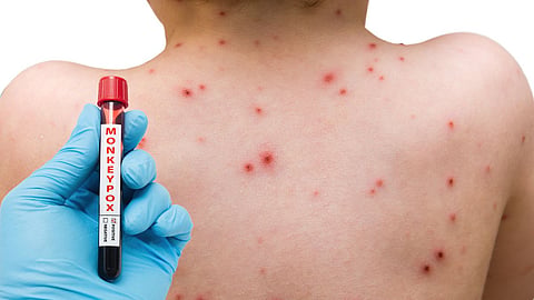 MonkeyPox