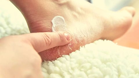 Cracked Heels Remedy at Home