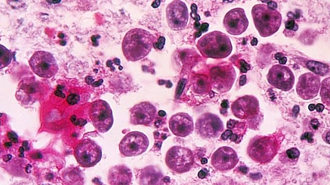 Brain Eating Amoeba