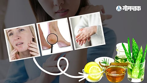 Dry Skin Treatment at Home