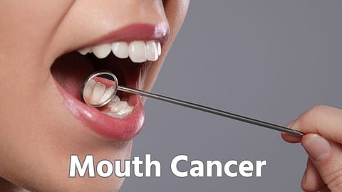 Mouth Cancer Symptoms