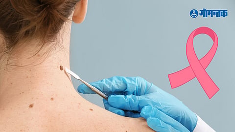 Skin Cancer