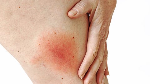 Lyme Disease
