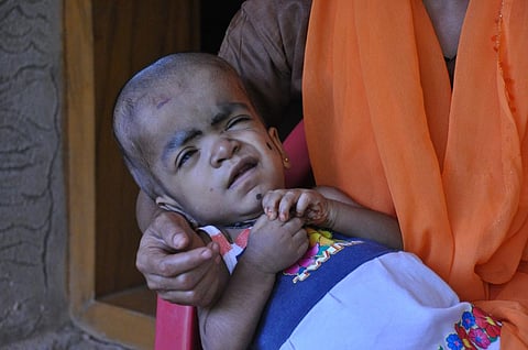 Two-year-old Saariya suffers from hydrocephalus and is enlisted in the beneficiary list (Savvy Soumya Misra/CSE) (January 2011)