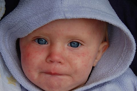 The world has to eradicate measles by 2020. Credit: Dave Haygarth/Flickr