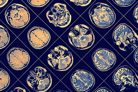 How AI may help diagnose mental illnesses