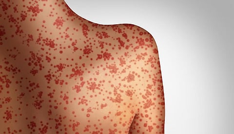 India among seven countries that contribute most to measles’ risk in US