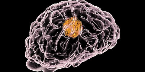 Protein marker for a deadly brain tumour identified