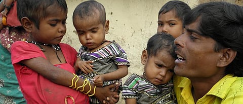 2 of 3 child deaths in India due to malnutrition: Report