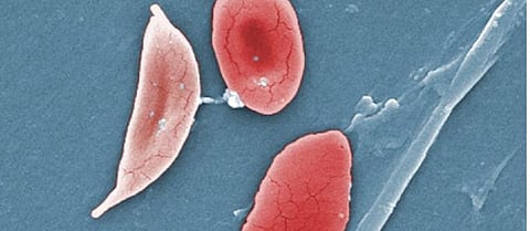 World Sickle Cell Day 2020 aims to increase awareness over sickle cell disorders