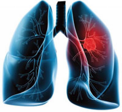 Learning lessons from across Europe – the hidden costs of COVID-19 on lung cancer