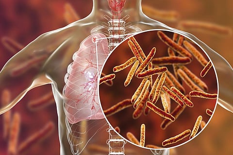 COVID-19: India to miss TB case notification target for 2021