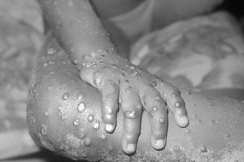 Monkeypox outbreak most geographically widespread in half a century