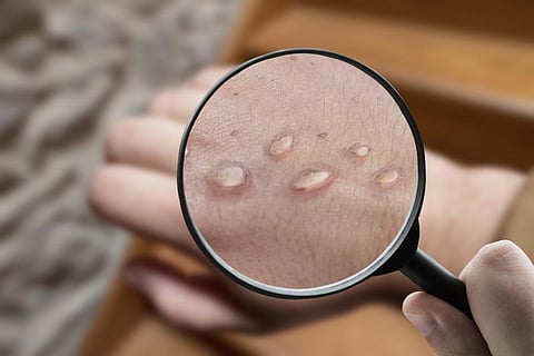Paediatric monkeypox case detected in the Netherlands
