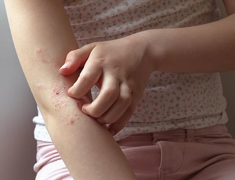New, more palatable medicine promotes gut bacteria to prevent all food allergies