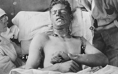 A Canadian soldier suffering from Mustard Gas burns during World War I. Photo: Library and Archives Canada, C-080027 via Wikimedia Commons