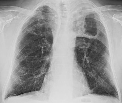 An X-Ray of the lungs of a tuberculosis patient. Photo: Wikimedia Commons