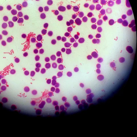 Bacteria (clusters of light pink, surrounded by larger magenta blood cells) can cause deadly infections, but overreactive immune responses can deliver the lethal blow. Photo: Scharvik/iStock via Getty Images Plus