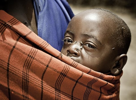 A child suffering from trachoma, an NTD. Representative Photo: iStock.