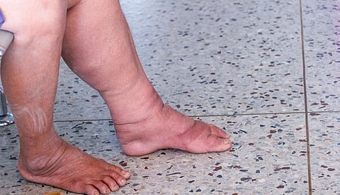 A filariasis patient. Photo: iStock
