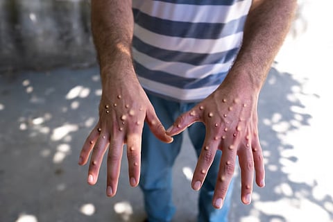 WHO prequalifies Danish MVA-BN vaccine to contain public health emergency posed by mpox