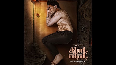 Kannada film ‘Bili Chukki, Halli Hakki’ draws attention to vitiligo, a disease shrouded in myth and stigma